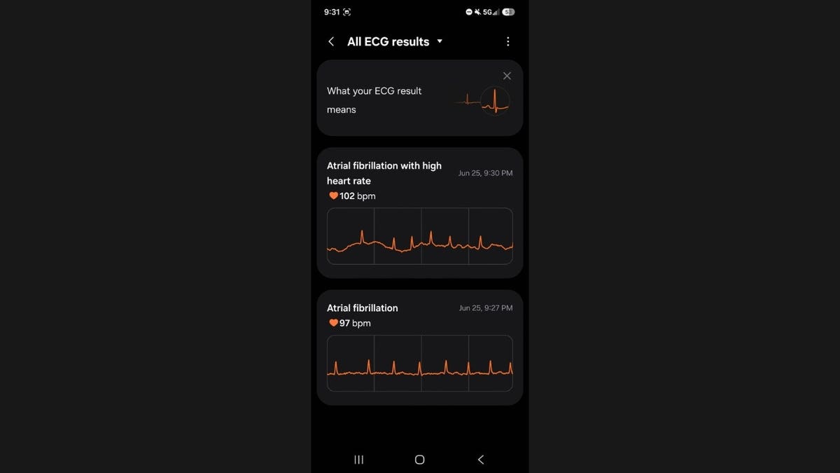 An afib reading